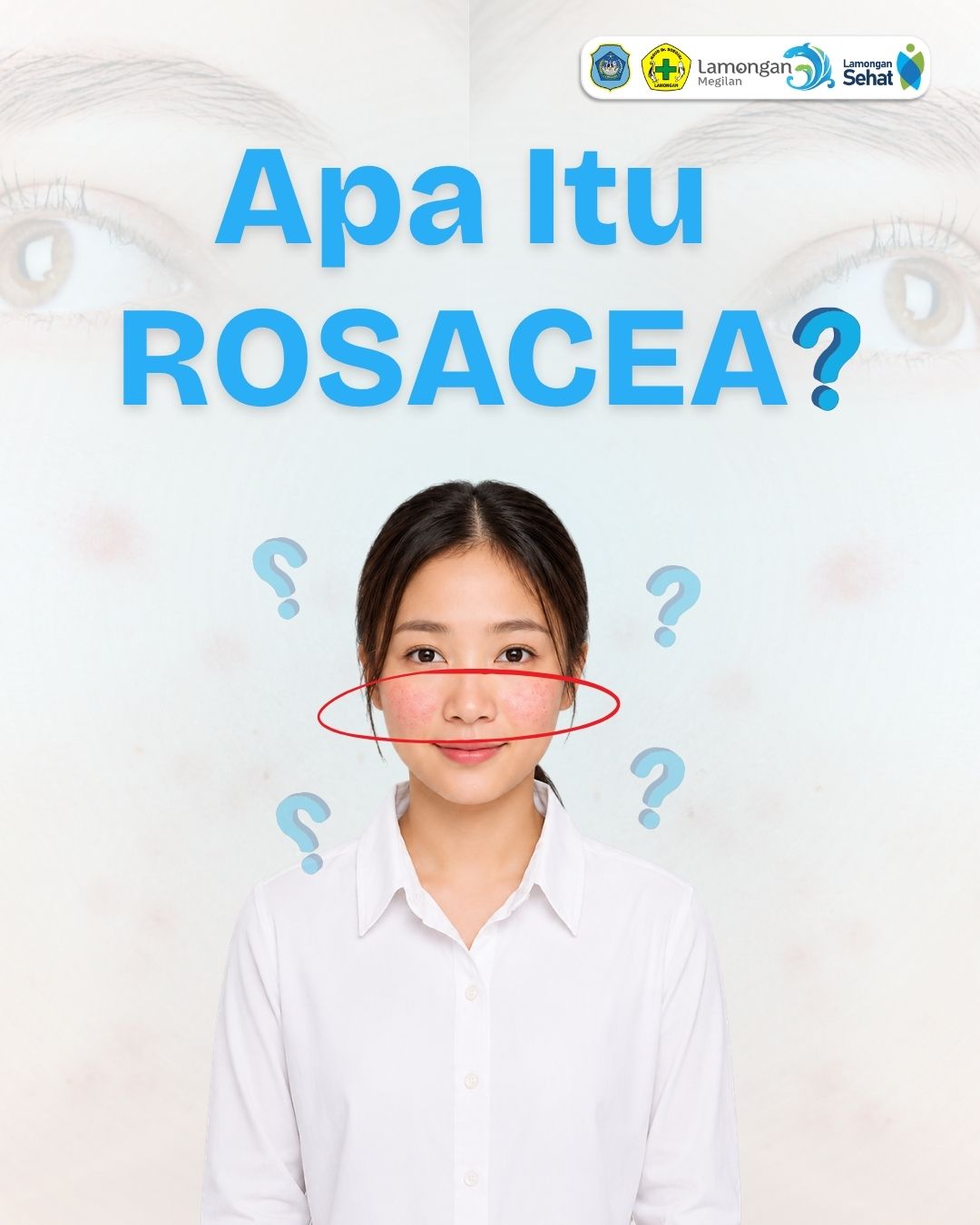 Apa Itu Rosacea ?