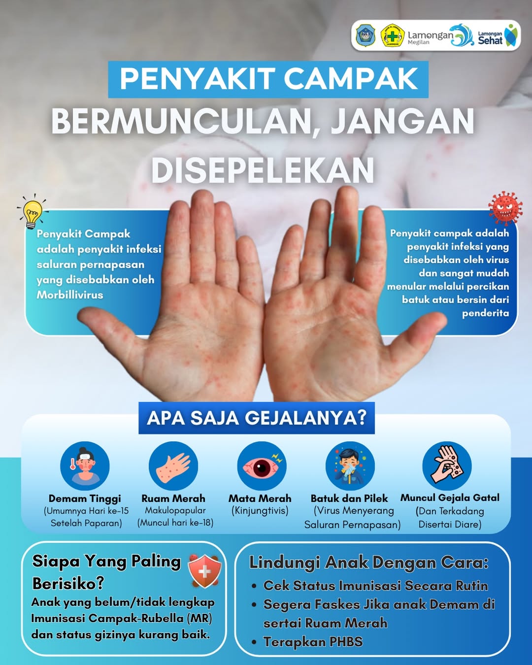 Foto: Jangan Sepelekan Penyakit Campak